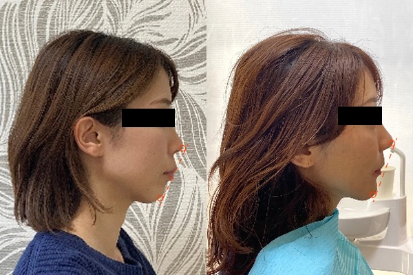 症例02 顔全体Before / After