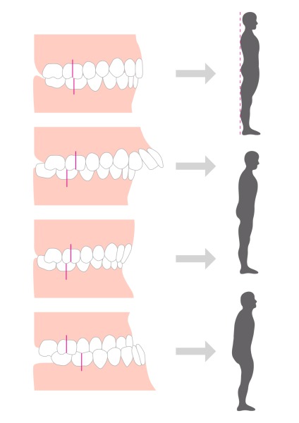 噛み合わせ、歯並びと姿勢の関係図｜姿勢と噛み合わせや歯並びの意外な関係