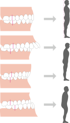 噛み合わせや歯並びと姿勢の関係図｜姿勢と噛み合わせや歯並びの意外な関係