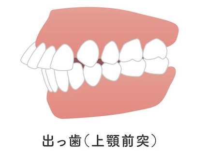 出っ歯（上顎前突）の画像｜「噛み合わせ」と「歯周病」の意外な関係｜歯科医師会田の噛み合わせメディア-カムシル