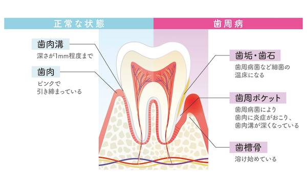 歯周病の歯の図解｜「噛み合わせ」と「歯周病」の意外な関係｜歯科医師会田の噛み合わせメディア-カムシル