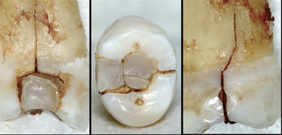 亀裂により歯の内部から虫歯になった画像②｜保存版！2022年最新「虫歯」の原因と予防法｜歯科医師会田のカムメディア〜カムシル〜