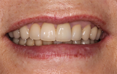 蓋咬合（ディープバイト）の治療例と予防法｜治療後1