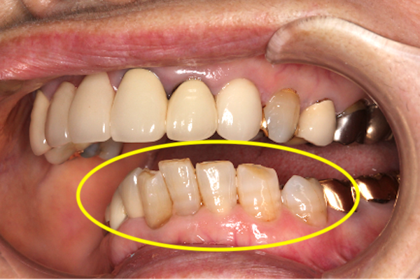 過蓋咬合（ディープバイト）の治療例と予防法｜治療詳細2-1補足