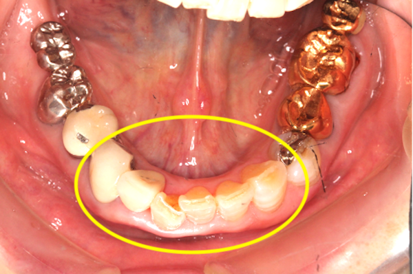 過蓋咬合（ディープバイト）の治療例と予防法｜治療詳細3-1補足