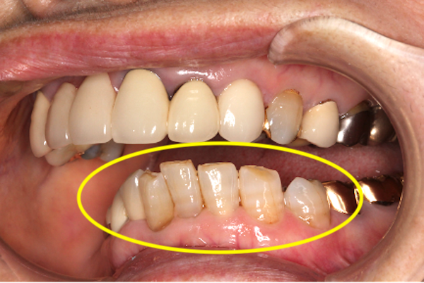 カムシル｜「過蓋咬合（ディープバイト）」の治療例と予防法｜治療詳細2-1補足