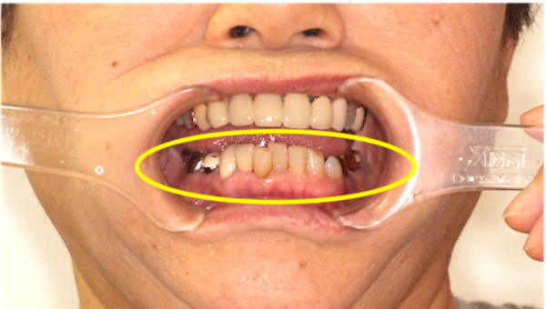カムシル｜「過蓋咬合（ディープバイト）」の治療例と予防法｜治療詳細2-2補足