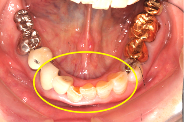 カムシル｜「過蓋咬合（ディープバイト）」の治療例と予防法｜治療詳細3-1補足