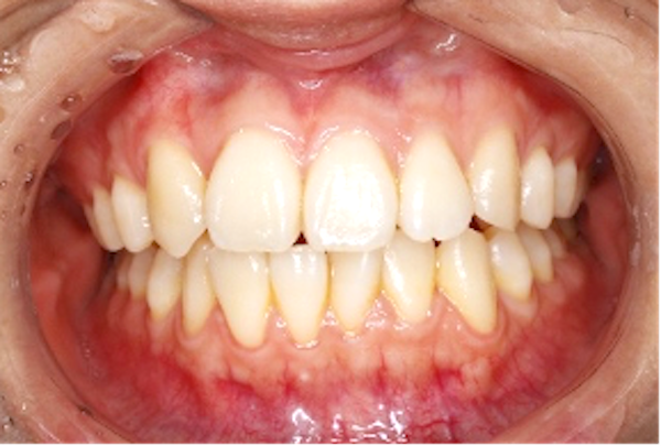 歯科医師会田の噛み合わせメディア〜カムシル〜｜慢性頭痛、顎の疲労・歪みを引き起こす噛み合わせの治療例｜治療前中央4
