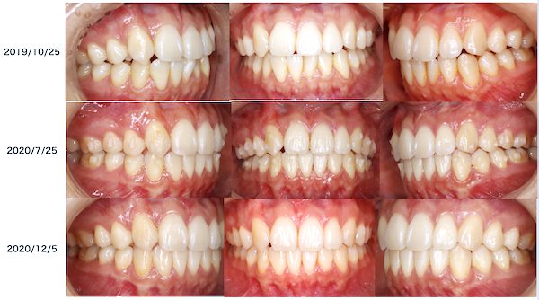 歯科医師会田の噛み合わせメディア〜カムシル〜｜慢性頭痛、顎の疲労・歪みを引き起こす噛み合わせの治療例｜治療前後の比較8