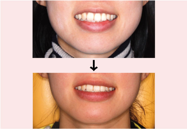 歯科医師会田の噛み合わせメディア〜カムシル〜｜慢性頭痛、顎の疲労・歪みを引き起こす噛み合わせの治療例｜治療前後の比較アイキャッチ画像8