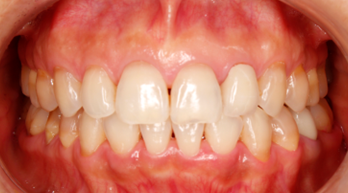 顔の歪み、くいしばりを起こす噛み合わせの治療例｜治療後の歯の画像1