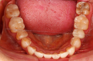 顔の歪み、くいしばりを起こす噛み合わせの治療例｜治療後の歯の画像2
