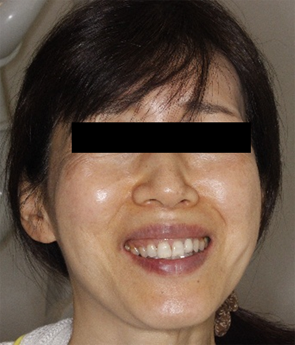 顔の歪み、くいしばりを起こす噛み合わせの治療例｜治療前の患者様の画像