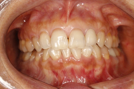 顔の歪み、くいしばりを起こす噛み合わせの治療例｜治療前の歯の画像