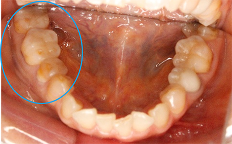 顔の歪み、くいしばりを起こす噛み合わせの治療例｜治療前の歯の画像2