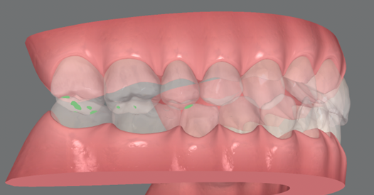 顔の歪み、くいしばりを起こす噛み合わせの治療例｜治療前の歯の3D画像1