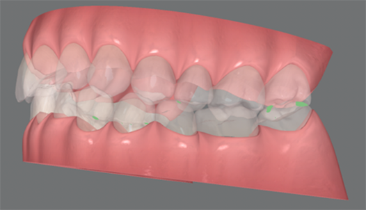 顔の歪み、くいしばりを起こす噛み合わせの治療例｜治療前の歯の3D画像2