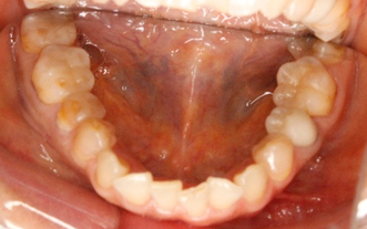 顔の歪み、くいしばりを起こす噛み合わせの治療例｜治療前の歯の画像