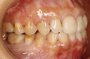 顔の歪み、くいしばりを起こす噛み合わせの治療例｜治療前の歯の画像3