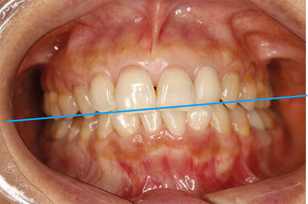 顔の歪み、くいしばりを起こす噛み合わせの治療例｜治療前の歯の画像1