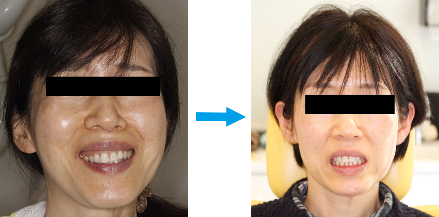 噛み合わせ治療前後の比較写真