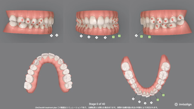 顔の歪み、くいしばりを起こす噛み合わせの治療例｜インビザラインによる治療計画の動画