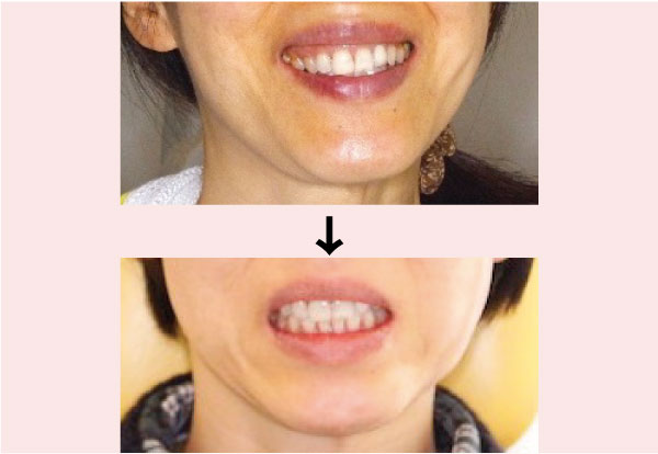 噛み合わせ治療前後の比較写真