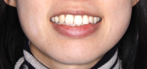 慢性頭痛、顎の疲労・歪みを引き起こす噛み合わせの治療例｜治療前の画像