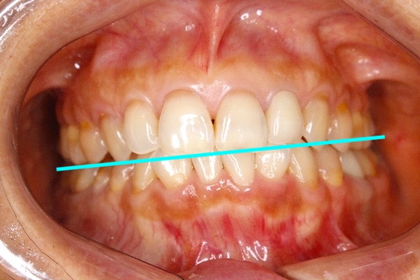 歯科医師会田の噛み合わせメディア〜カムシル〜｜顔の歪み、くいしばりを起こす噛み合わせの治療例｜治療前の歯の画像1