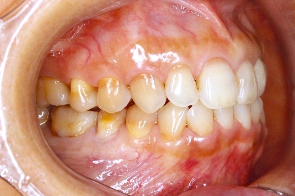 歯科医師会田の噛み合わせメディア〜カムシル〜｜顔の歪み、くいしばりを起こす噛み合わせの治療例｜治療前の歯の画像3