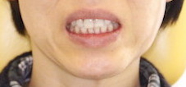歯科医師会田の噛み合わせメディア〜カムシル〜｜顔の歪み、くいしばりを起こす噛み合わせの治療例｜治療後の患者様の画像のコピー