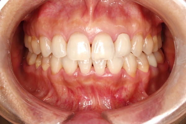 歯科医師会田の噛み合わせメディア〜カムシル〜｜顔の歪み、くいしばりを起こす噛み合わせの治療例｜治療後の歯の画像1