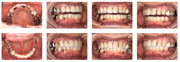 歯科医師会田の噛み合わせメディア〜カムシル〜｜噛み合わせが原因でトラブルを繰り返していた治療例｜治療画像2