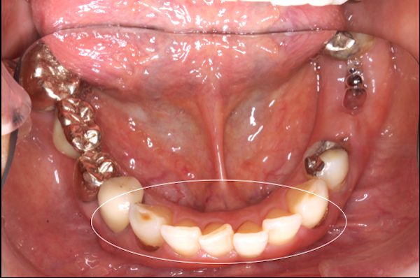歯科医師会田の噛み合わせメディア〜カムシル〜｜噛み合わせが原因でトラブルを繰り返していた治療例｜治療画像5