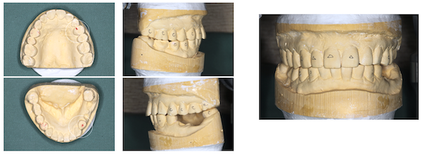 歯科医師会田の噛み合わせメディア〜カムシル〜｜噛み合わせが原因でトラブルを繰り返していた治療例｜治療画像7