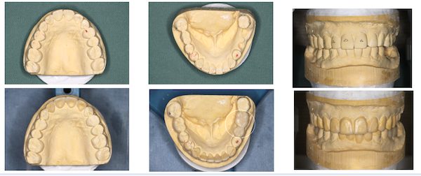 歯科医師会田の噛み合わせメディア〜カムシル〜｜噛み合わせが原因でトラブルを繰り返していた治療例｜治療画像9