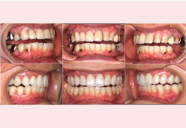 歯科医師会田の噛み合わせメディア〜カムシル〜｜噛み合わせが原因でトラブルを繰り返していた治療例｜治療画像アイキャッチ