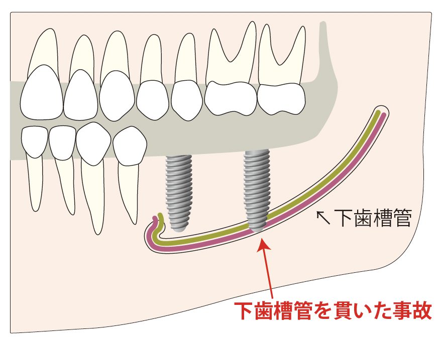 歯科医師会田の噛み合わせメディア〜カムシル〜｜2023年版！噛み合わせ作りに必要な「最新インプラント事情」｜下歯槽管の事故のイメージ画像