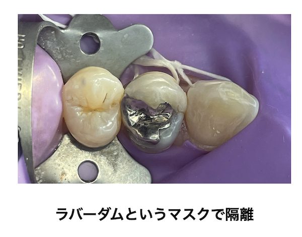 歯科医師会田の噛み合わせメディア〜カムシル〜｜皮膚科で治らないその症状、歯科医院で治る可能性も｜ラバーダムを使用している治療画像