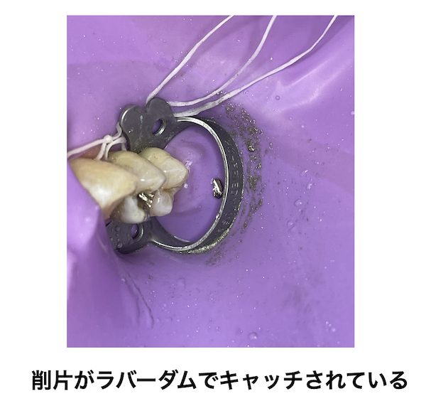 歯科医師会田の噛み合わせメディア〜カムシル〜｜皮膚科で治らないその症状、歯科医院で治る可能性も｜削片がラバーダムでキャッチされている画像