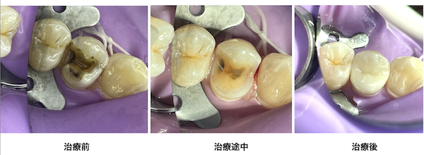 歯科医師会田の噛み合わせメディア〜カムシル〜｜皮膚科で治らないその症状、歯科医院で治る可能性も｜ラバーダムを使用した治療前後の比較画像