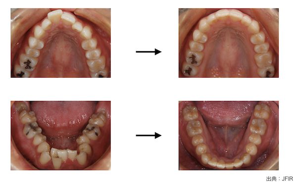 歯科医師会田の噛み合わせメディア〜カムシル〜｜皮膚科で治らないその症状、歯科医院で治る可能性も｜矯正治療を行い、口呼吸の改善を図った治療例の画像