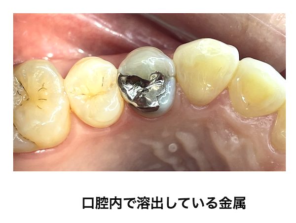 歯科医師会田の噛み合わせメディア〜カムシル〜｜皮膚科で治らないその症状、歯科医院で治る可能性も｜口腔内で溶出している金属の画像