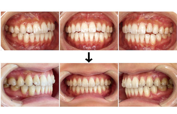 歯科医師会田の噛み合わせメディア〜カムシル〜｜前歯が噛み合わない人は要注意！奥歯がしみるのは前歯が原因？｜治療前後の比較画像