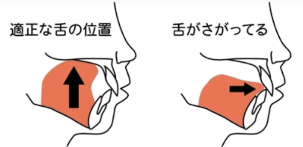 歯科医師会田の噛み合わせメディア〜カムシル〜｜前歯が噛み合わない人は要注意！奥歯がしみるのは前歯が原因？｜舌の位置の解説イラスト