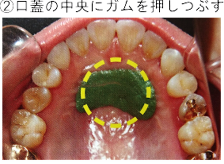 歯科医師会田の噛み合わせメディア〜カムシル〜｜前歯が噛み合わない人は要注意！奥歯がしみるのは前歯が原因？｜ガムトレーニング中の口腔内の画像2