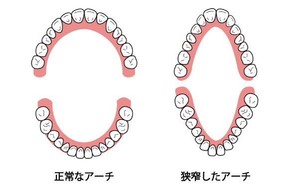 歯科医師会田の噛み合わせメディア〜カムシル〜｜前歯が噛み合わない人は要注意！奥歯がしみるのは前歯が原因？｜正常歯列と狭窄歯列の比較画像