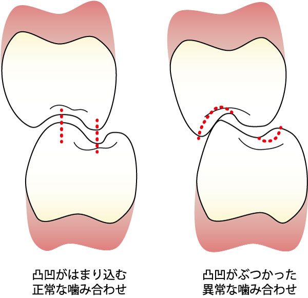 歯科医師会田の噛み合わせメディア〜カムシル〜｜前歯が噛み合わない人は要注意！奥歯がしみるのは前歯が原因？｜歯の凸凹の比較画像