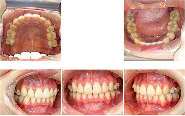 歯科医師会田の噛み合わせメディア〜カムシル〜｜前歯が噛み合わない人は要注意！奥歯がしみるのは前歯が原因？｜治療後の歯の画像